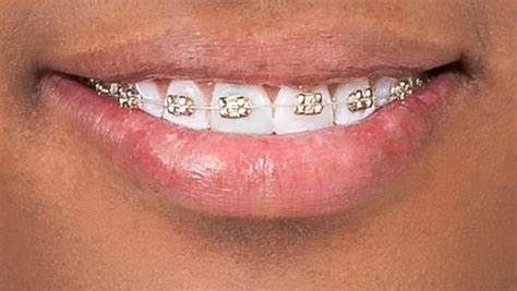 clear braces